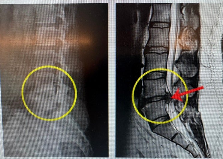 허리디스크 수술 후 운동법